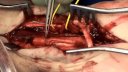 Median Nerve Repair Using a Nerve Conduit